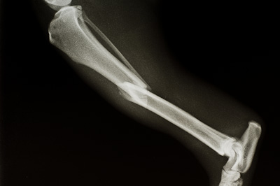 A fractured tibia